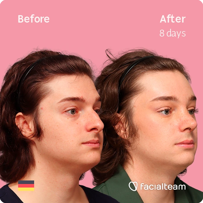 Angled right square image of FFS patient Lilly T. showing the results before-after with Facialteam consisting of forehead and rhinoplasty feminization surgery.