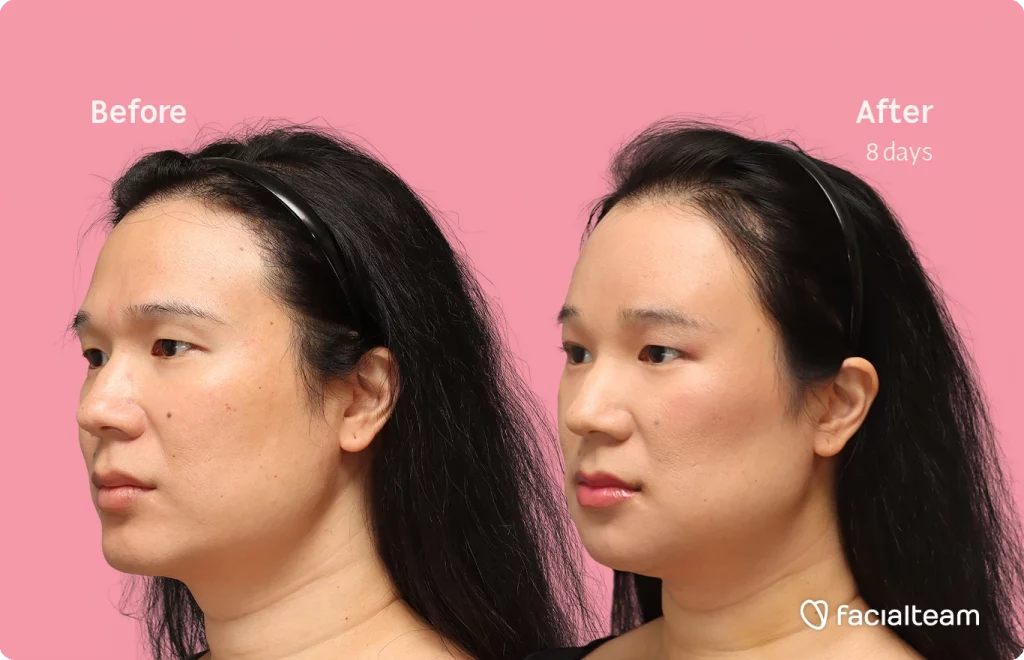 Angled left image of FFS patient Shyan showing the results before-after with Facialteam consisting of forehead, chin and Jaw feminization surgery and HIFU as complementary procedure.