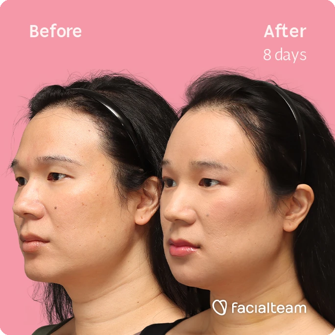 Angled square left image of FFS patient Shyan showing the results before-after with Facialteam consisting of forehead, chin and Jaw feminization surgery and HIFU as complementary procedure.