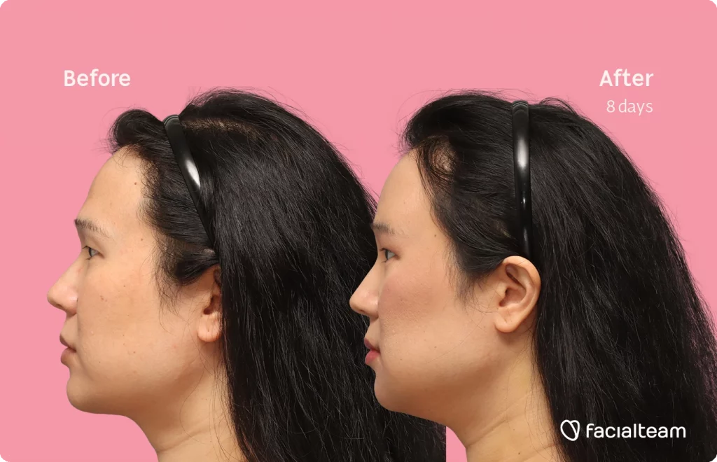 Side left image of FFS patient Shyan showing the results before-after with Facialteam consisting of forehead, chin and Jaw feminization surgery and HIFU as complementary procedure.