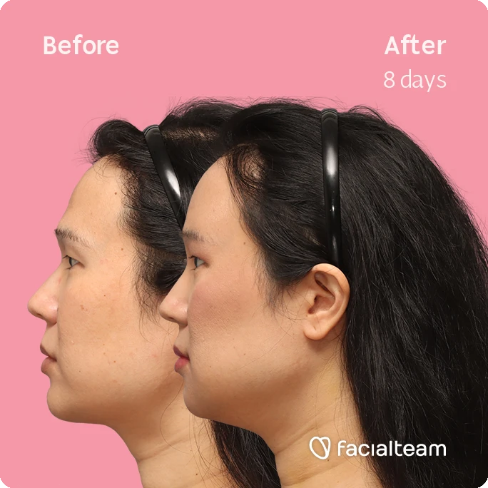 Side left square image of FFS patient Shyan showing the results before-after with Facialteam consisting of forehead, chin and Jaw feminization surgery and HIFU as complementary procedure.