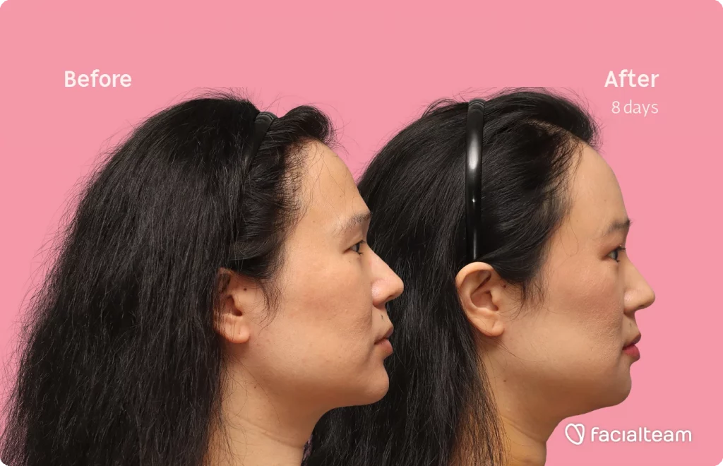 Side right image of FFS patient Shyan showing the results before-after with Facialteam consisting of forehead, chin and Jaw feminization surgery and HIFU as complementary procedure.