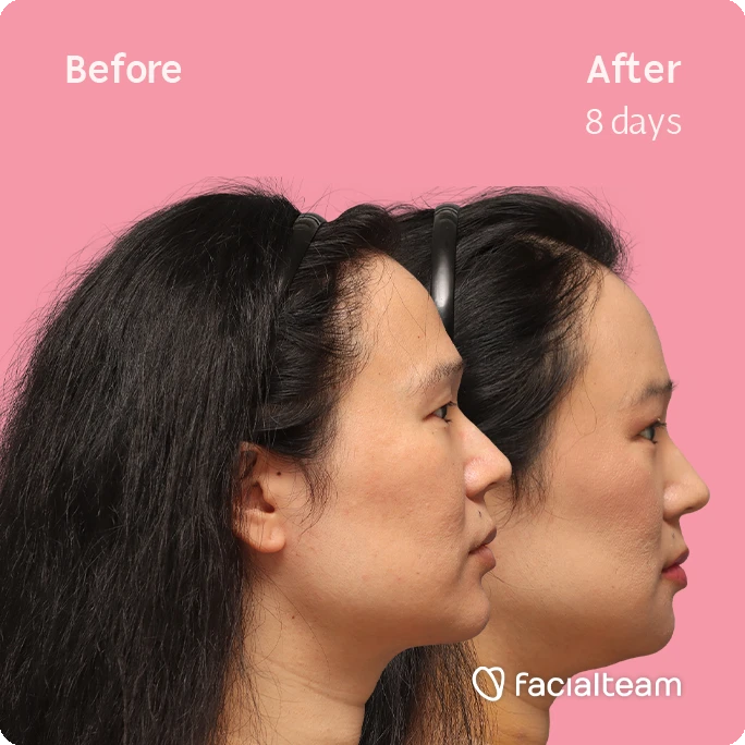 Side right square image of FFS patient Shyan showing the results before-after with Facialteam consisting of forehead, chin and Jaw feminization surgery and HIFU as complementary procedure.