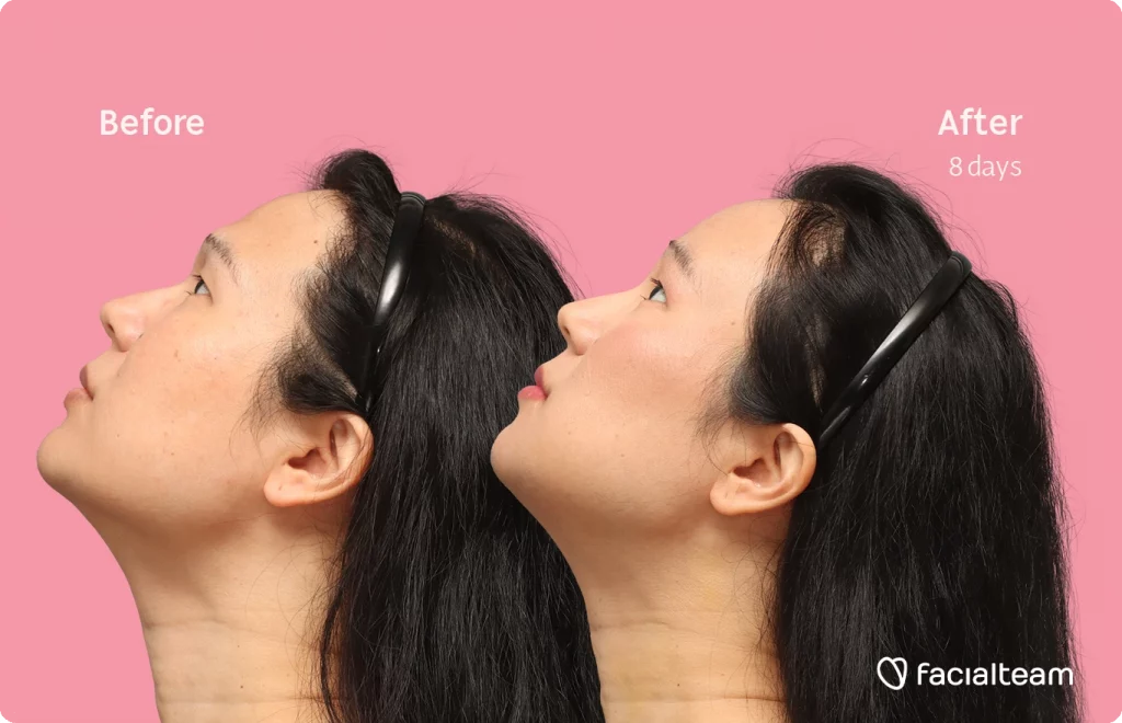 Side left up image of FFS patient Shyan showing the results before-after with Facialteam consisting of forehead, chin and Jaw feminization surgery and HIFU as complementary procedure.
