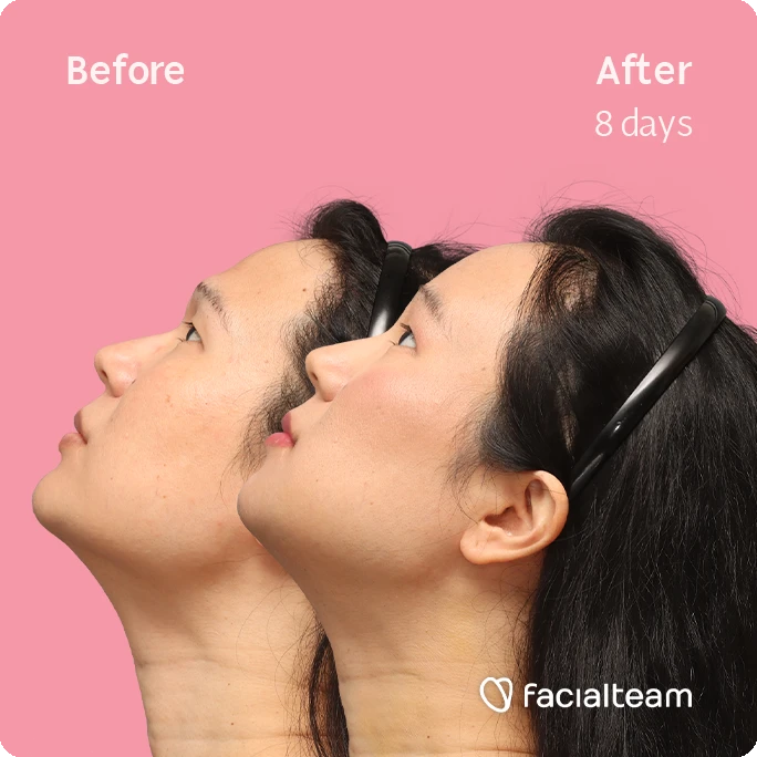 Side left up square image of FFS patient Shyan showing the results before-after with Facialteam consisting of forehead, chin and Jaw feminization surgery and HIFU as complementary procedure.