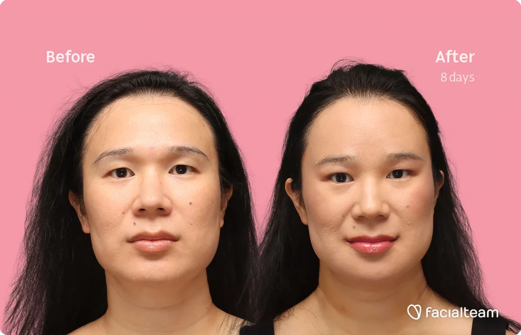 Frontal image of FFS patient Shyan showing the results before-after with Facialteam consisting of forehead, chin and Jaw feminization surgery and HIFU as complementary procedure.