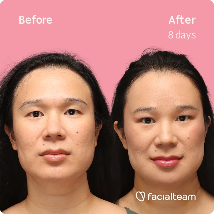Frontal square image of FFS patient Shyan showing the results before-after with Facialteam consisting of forehead, chin and Jaw feminization surgery and HIFU as complementary procedure.
