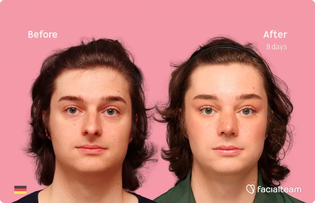 Frontal image of FFS patient Lilly T. showing the results before-after with Facialteam consisting of forehead and rhinoplasty feminization surgery.