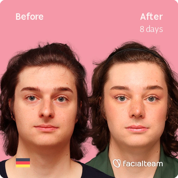 Frontal square image of FFS patient Lilly T. showing the results before-after with Facialteam consisting of forehead and rhinoplasty feminization surgery.