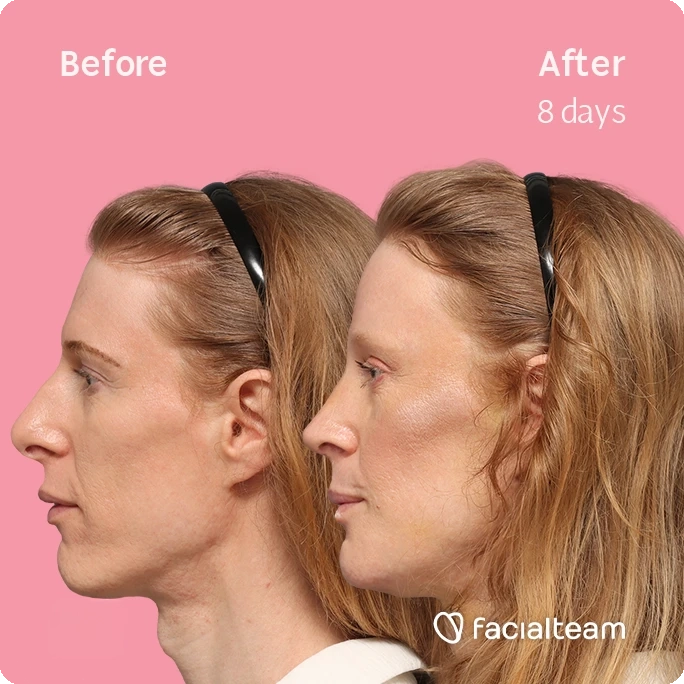 Side left square image of FFS patient Laura M. showing the results before-after with Facialteam consisting of forehead, rhinoplasty, chin, tracheal shave feminization surgery and HIFU as secondary procedure.
