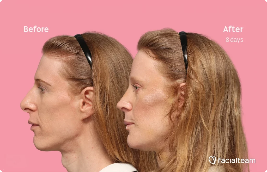Side left image of FFS patient Laura M. showing the results before-after with Facialteam consisting of forehead, rhinoplasty, chin, tracheal shave feminization surgery and HIFU as secondary procedure.