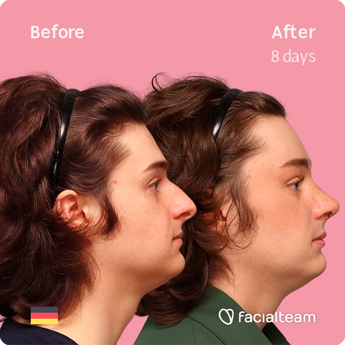 Side right square image of FFS patient Lilly T. showing the results before-after with Facialteam consisting of forehead and rhinoplasty feminization surgery.