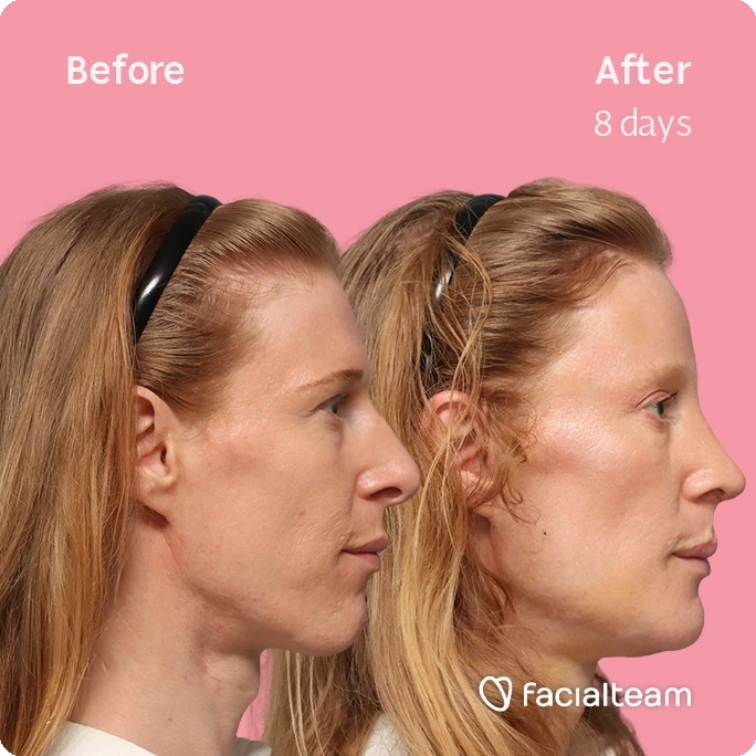 Side right square image of FFS patient Laura M. showing the results before-after with Facialteam consisting of forehead, rhinoplasty, chin, tracheal shave feminization surgery and HIFU as secondary procedure.