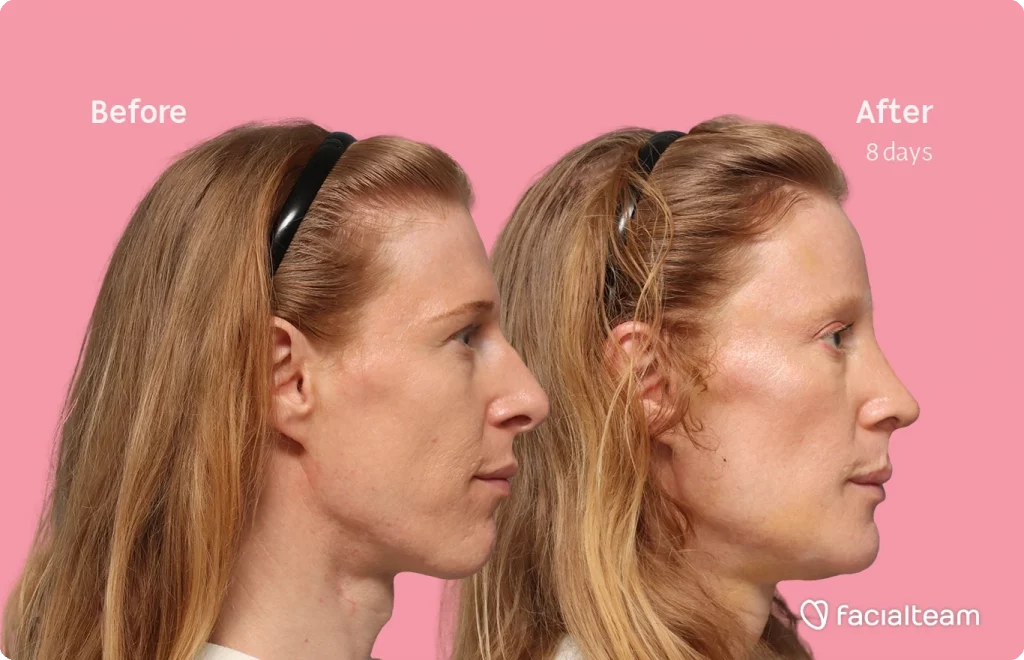 Side right image of FFS patient Laura M. showing the results before-after with Facialteam consisting of forehead, rhinoplasty, chin, tracheal shave feminization surgery and HIFU as secondary procedure.