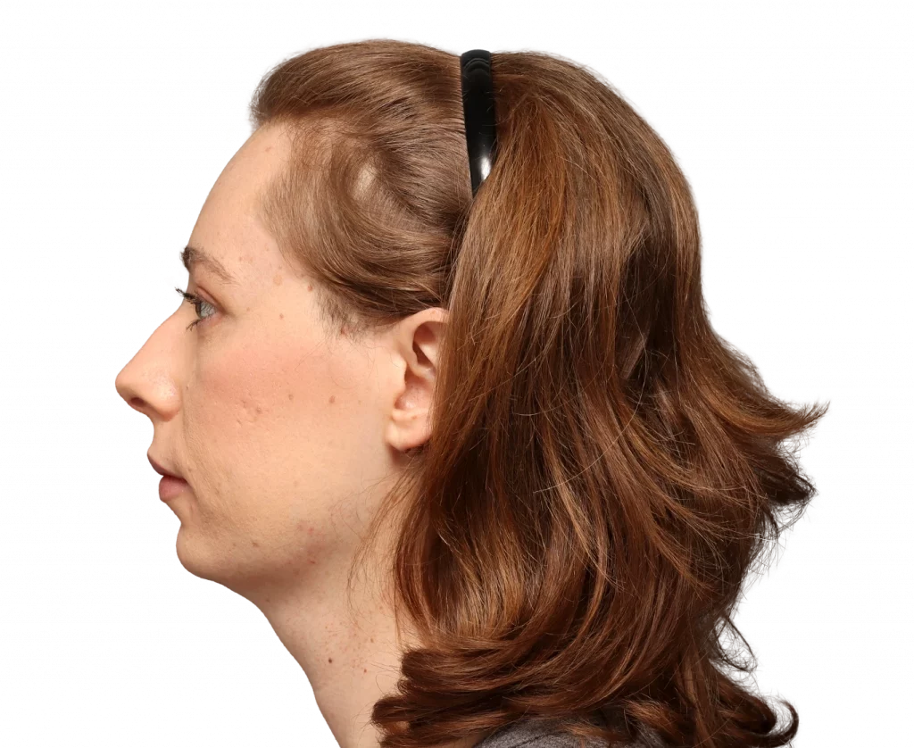 side left profile photo of Chloe after surgery.