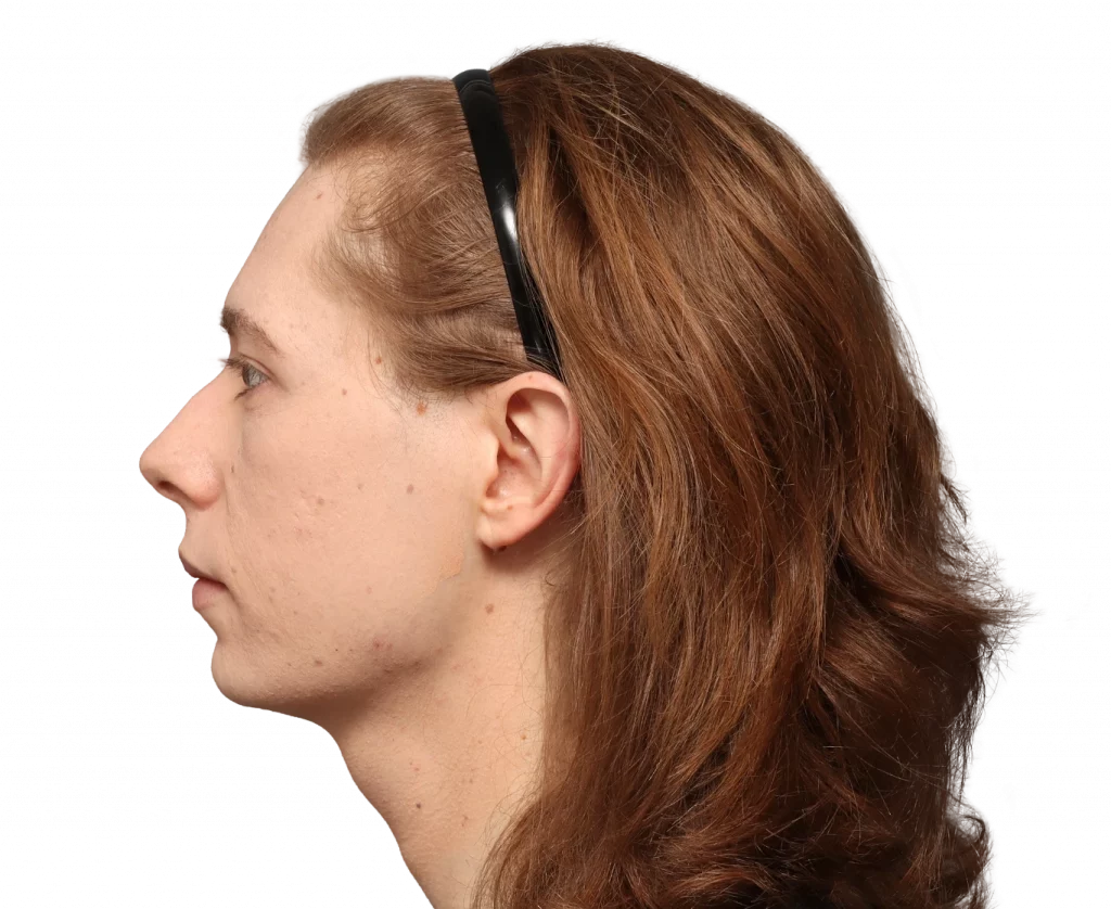 Side left profile photo of Chloe before surgery.