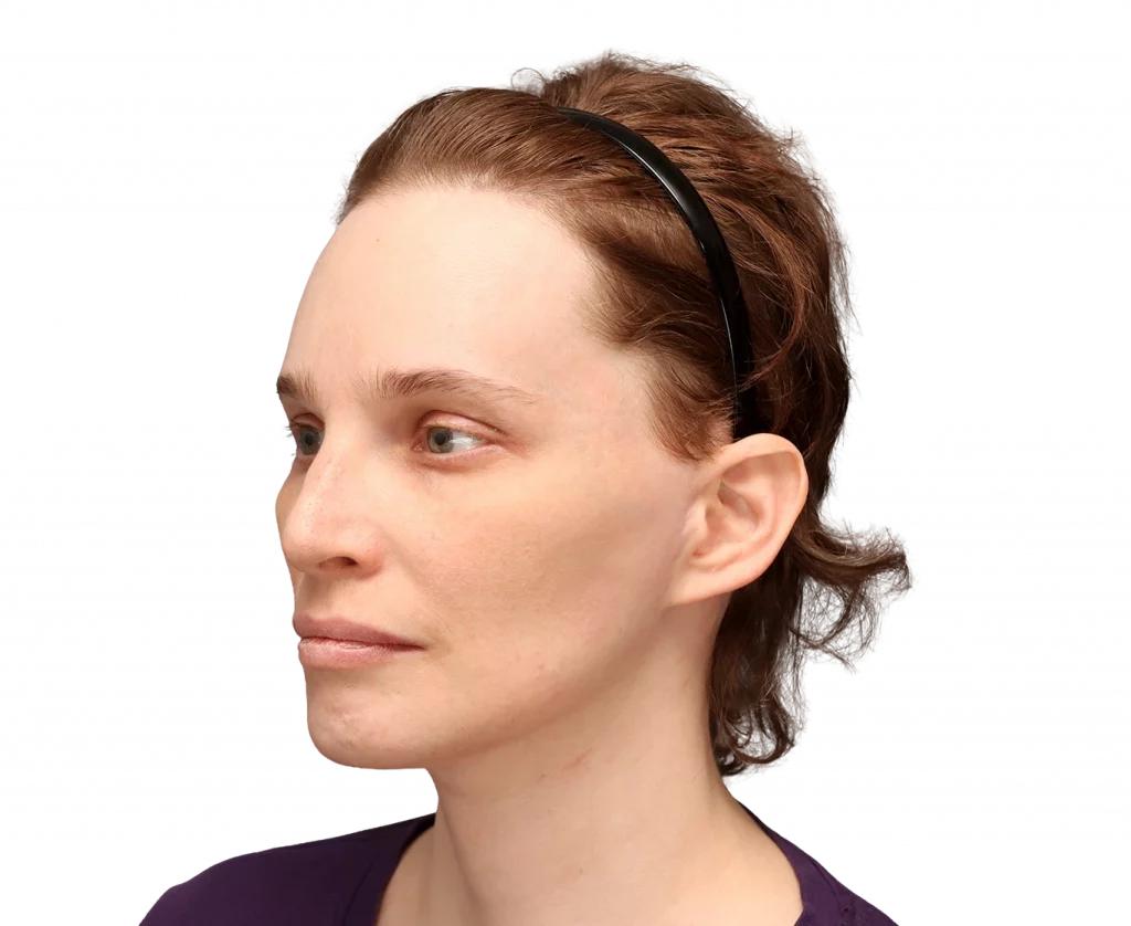 Angled left profile photo of Heather L. after surgery.