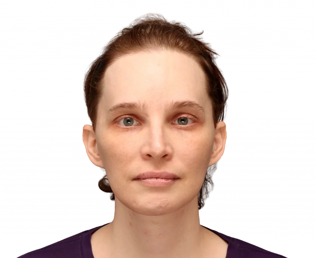 Frontal profile photo of Heather L. after surgery.