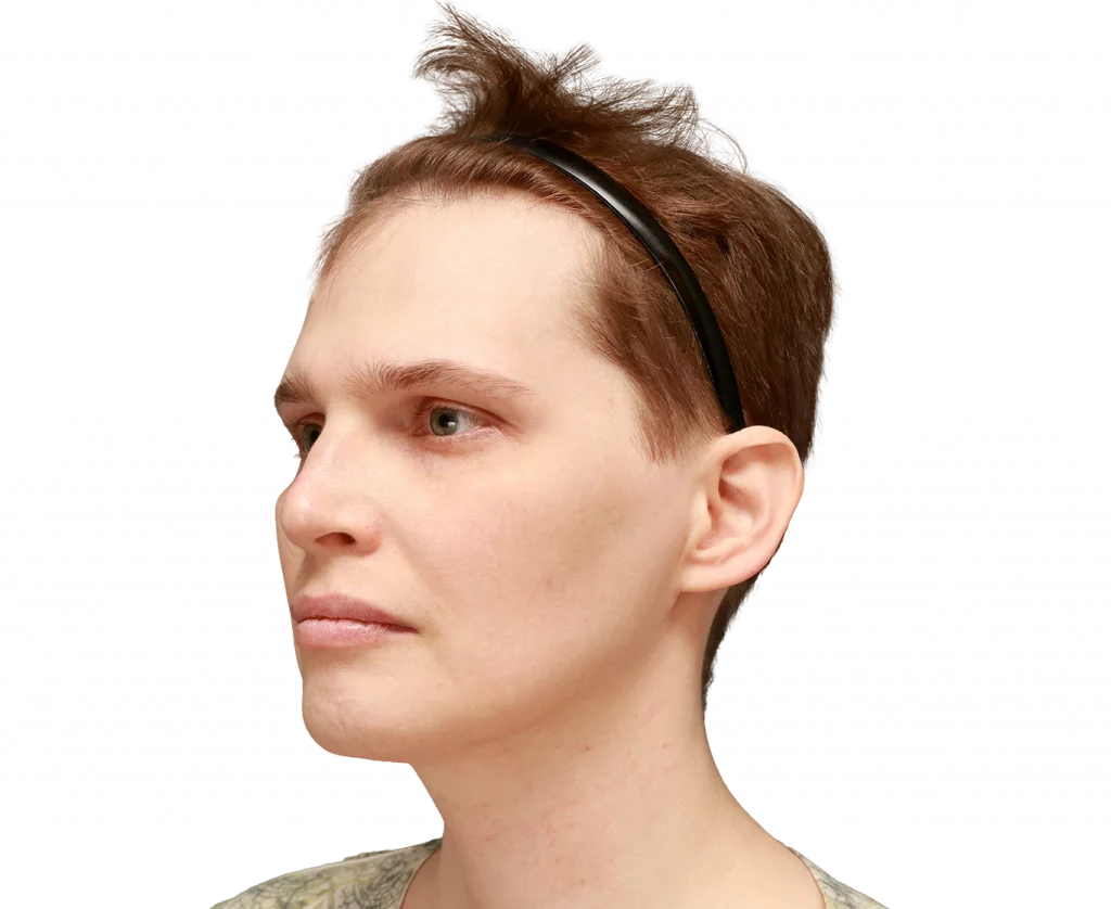 Angled left profile photo of Heather L. before surgery.