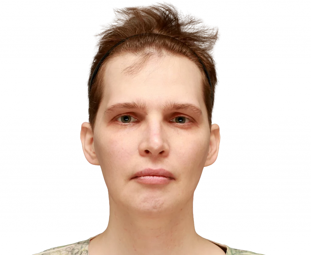 frontal profile photo of Heather L. before surgery.