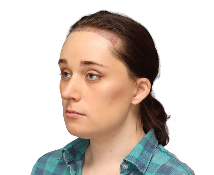 Angled left profile photo of Jessie B. after surgery.
