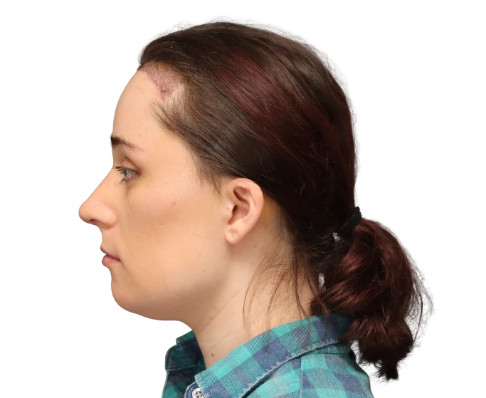 Side left profile photo of Jessie B. after surgery.