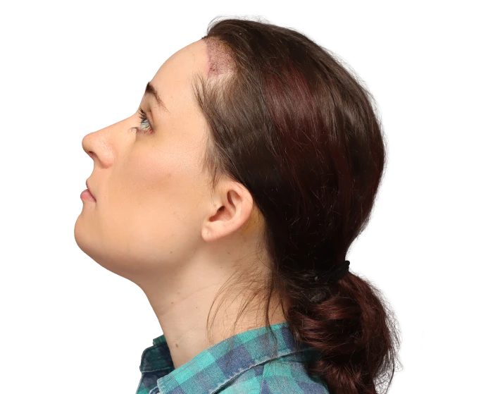 Side up left profile photo of Jessie B. after surgery.
