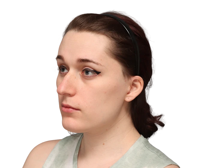 Angled profile photo of Jessie B. before surgery.