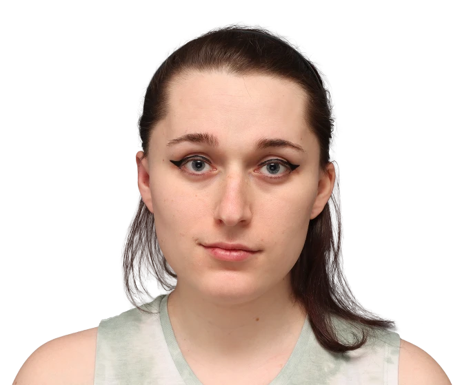 Frontal profile photo of Jessie B. before surgery.