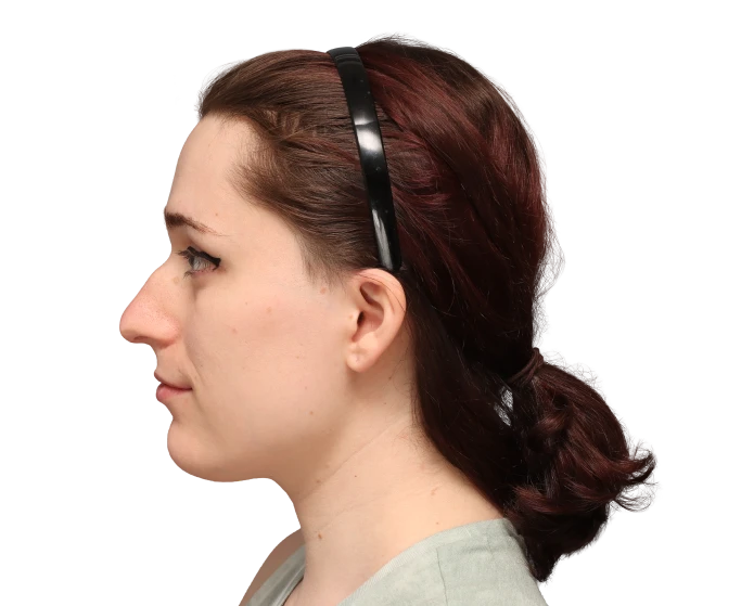 Side left profile photo of Jessie B. before surgery.