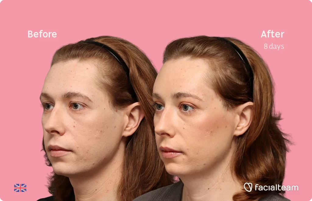 Angled left image of FFS patient Chloe showing the results before-after with Facialteam consisting of forehead feminization surgery.