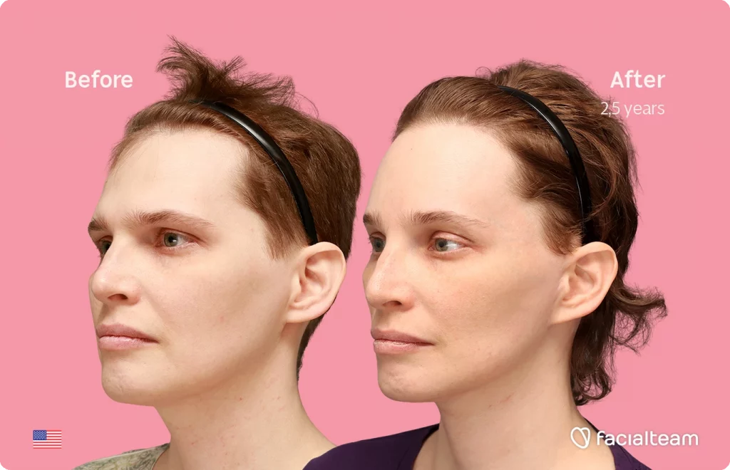 Angled right image of FFS patient Heather L. showing the results before-after with Facialteam consisting of forehead with SHT and tracheal shave feminization surgery.