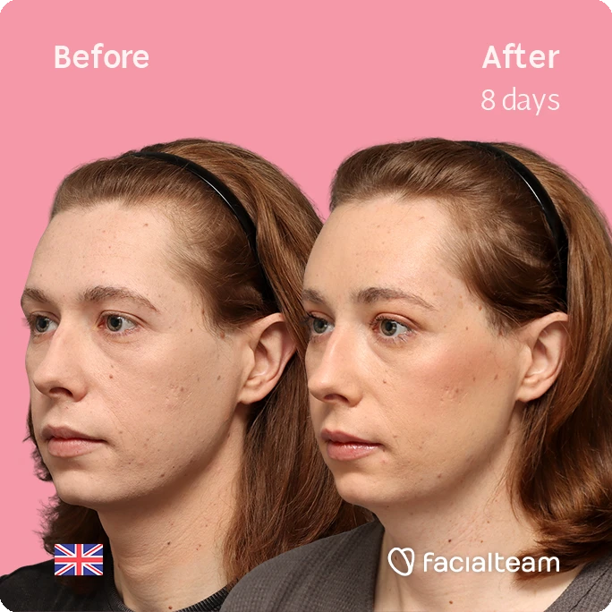 Angled left square image of FFS patient Chloe showing the results before-after with Facialteam consisting of forehead feminization surgery.