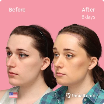 Angled left square image of FFS patient Jessie B. showing the results before-after with Facialteam consisting of forehead with SHT, rhinoplasty and chin feminization surgery.