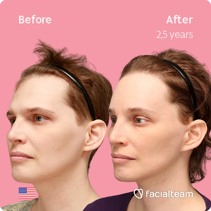 Angled right square image of FFS patient Heather L. showing the results before-after with Facialteam consisting of forehead with SHT and tracheal shave feminization surgery.