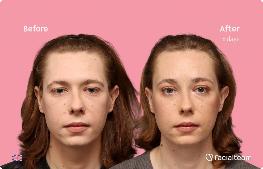 Frontal image of FFS patient Chloe showing the results before-after with Facialteam consisting of forehead feminization surgery.