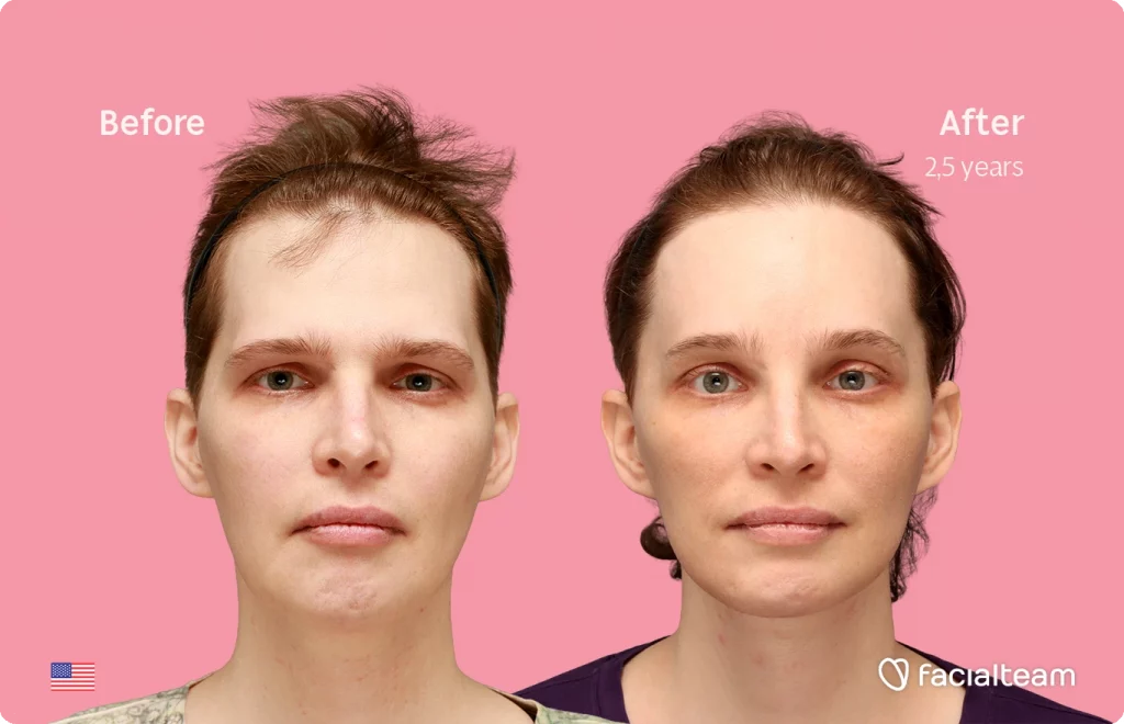 Frontal image of FFS patient Heather L. showing the results before-after with Facialteam consisting of forehead with SHT and tracheal shave feminization surgery.