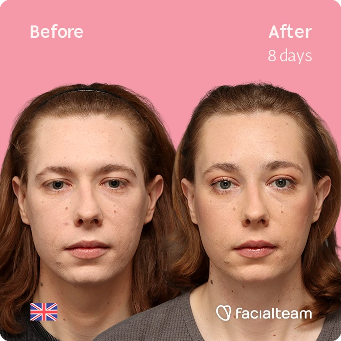 Frontal square image of FFS patient Chloe showing the results before-after with Facialteam consisting of forehead feminization surgery.