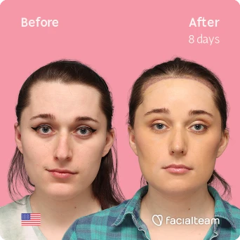 Frontal square image of FFS patient Jessie B. showing the results before-after with Facialteam consisting of forehead with SHT, rhinoplasty and chin feminization surgery.