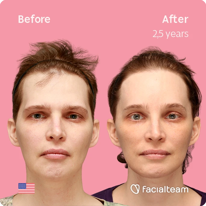 frontal square image of FFS patient Heather L. showing the results before-after with Facialteam consisting of forehead with SHT and tracheal shave feminization surgery.