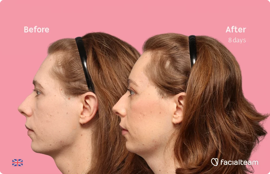Side left square image of FFS patient Chloe showing the results before-after with Facialteam consisting of forehead feminization surgery.