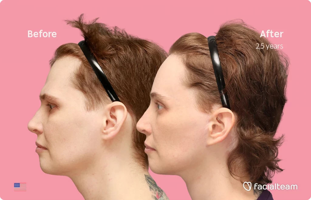 Side left image of FFS patient Heather L. showing the results before-after with Facialteam consisting of forehead with SHT and tracheal shave feminization surgery.