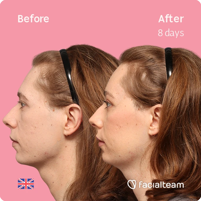 Side left square image of FFS patient Chloe showing the results before-after with Facialteam consisting of forehead feminization surgery.
