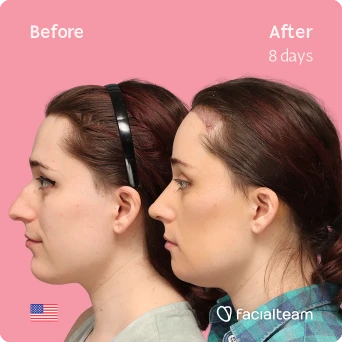 Side left square image of FFS patient Jessie B. showing the results before-after with Facialteam consisting of forehead with SHT, rhinoplasty and chin feminization surgery.