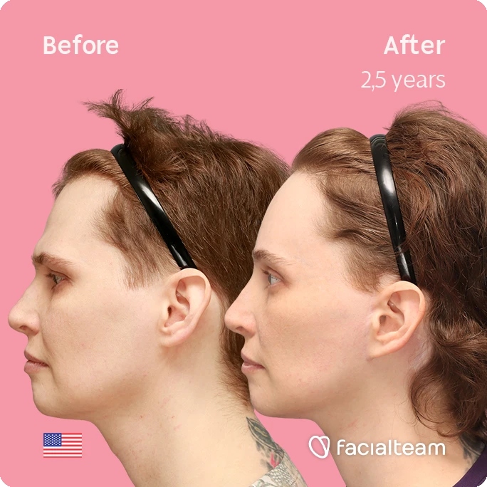 Side left square image of FFS patient Heather L. showing the results before-after with Facialteam consisting of forehead with SHT and tracheal shave feminization surgery.