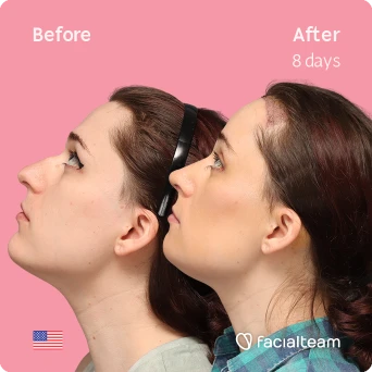 Side left up square image of FFS patient Jessie B. showing the results before-after with Facialteam consisting of forehead with SHT, rhinoplasty and chin feminization surgery.
