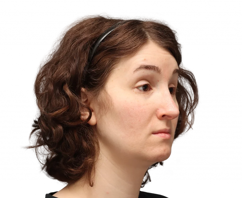 Angled right profile photo of Arly after surgery.