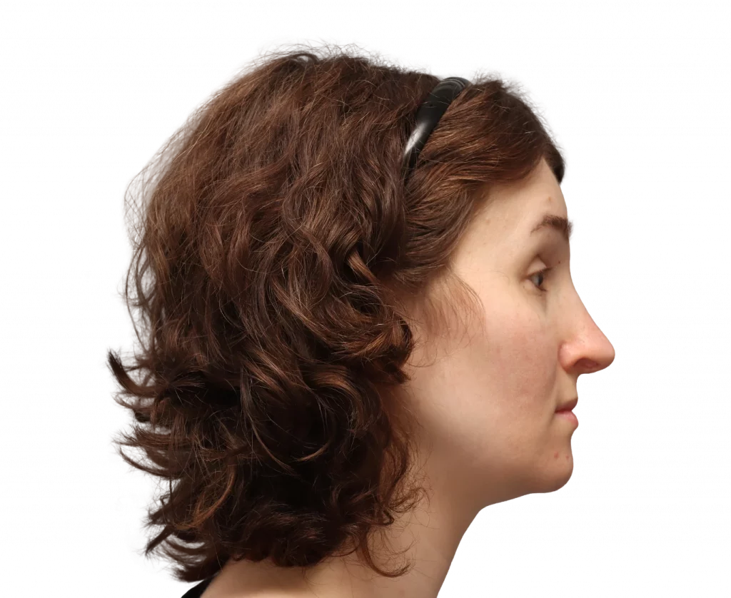 Side profile photo of Arly after surgery.
