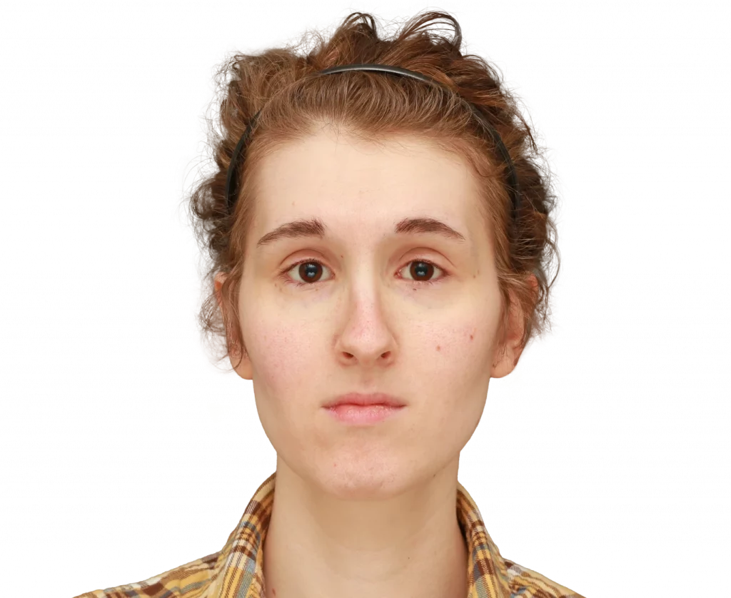 Front profile photo of Arly before surgery.