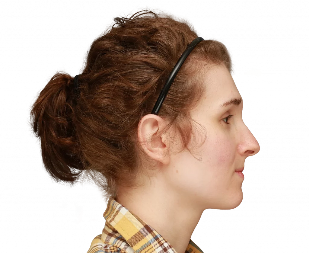 Side profile photo of Arly before surgery.